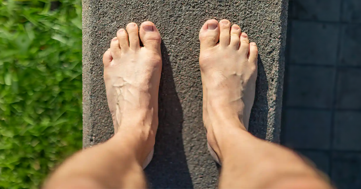 PIED LARGE : ORIGINES, SIGNES CARACTÉRISTIQUES ET COMPLICATIONS