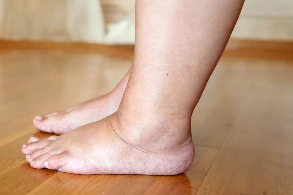 Causes et maladies responsables du gonflement des pieds