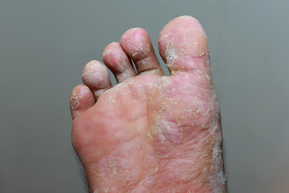 Comment soigner une mycose des pieds rapidement ?