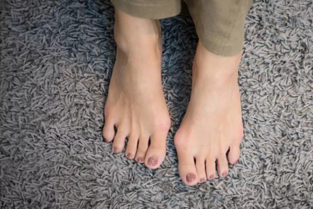 Qu'est-ce qui cause le hallux valgus ? Découvrez les principales raisons et facteurs de risque