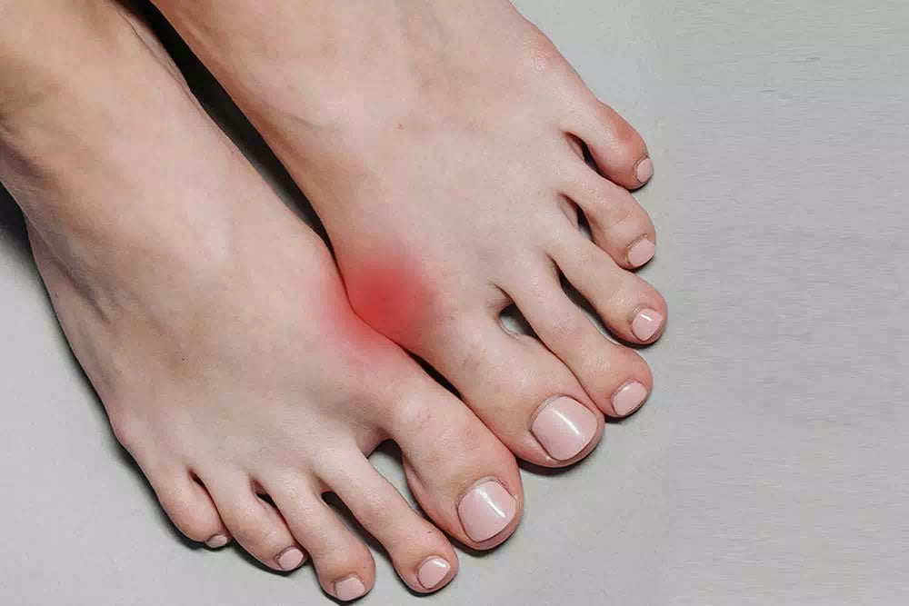 Est-il possible de corriger un hallux valgus sans chirurgie ?