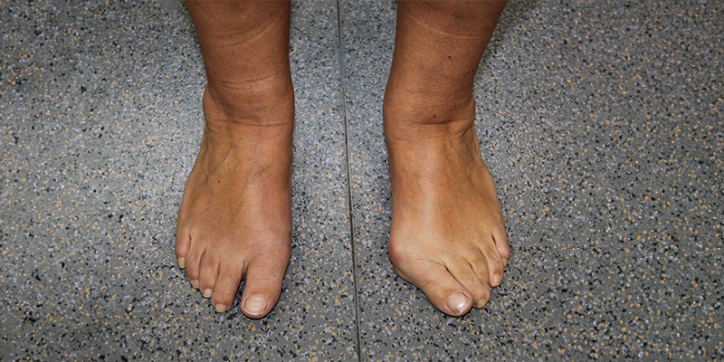 Hallux Valgus : ORIGINES, SYMPTÔMES DISTINCTIFS ET COMPLICATIONS