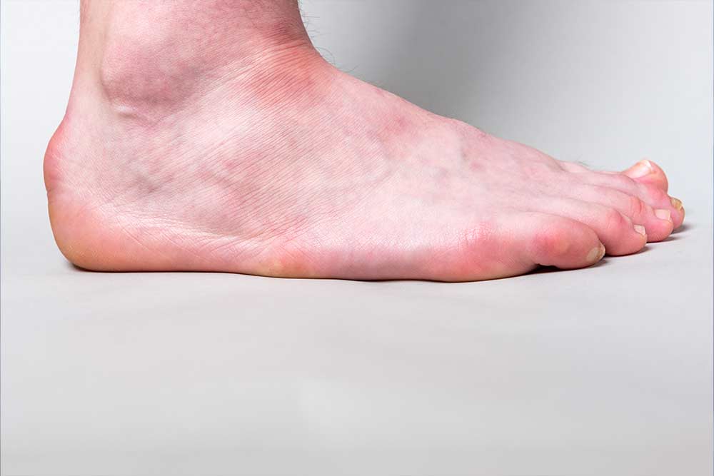 Un seul pied gonflé sur le dessus : causes, symptômes et traitements efficaces