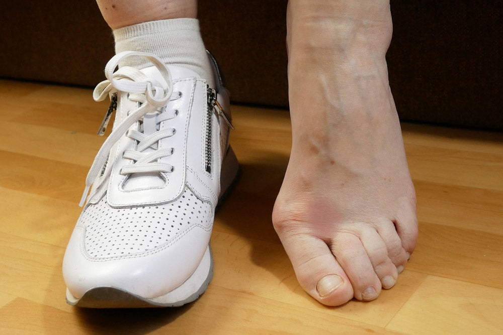 Reprendre la course après une opération d'hallux valgus