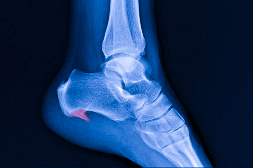 Comment soulager une épine sous le pied ?